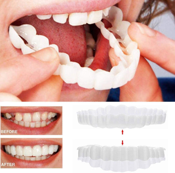 Smile Veneers | Dental Cosmetic Overlay-Veneers-Lightsnest