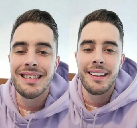 Smile Veneers | Dental Cosmetic Overlay-Veneers-Lightsnest