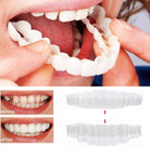 Smile Veneers | Dental Cosmetic Overlay-Veneers-Lightsnest