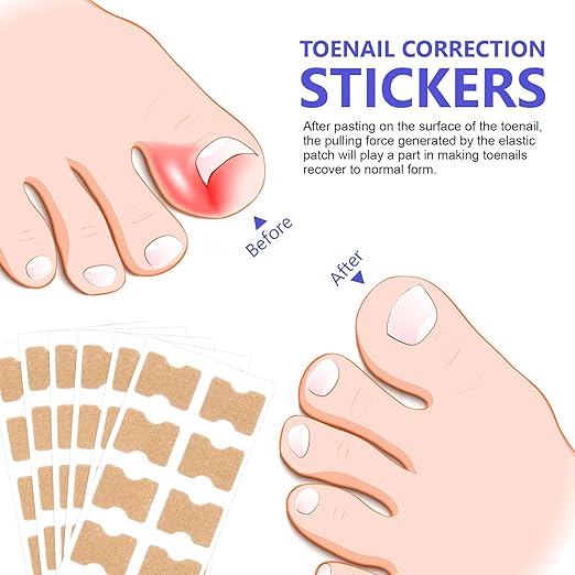 Fungus Nail Patches | Ingrown Nail Treatment-Nail Patches-Lightsnest