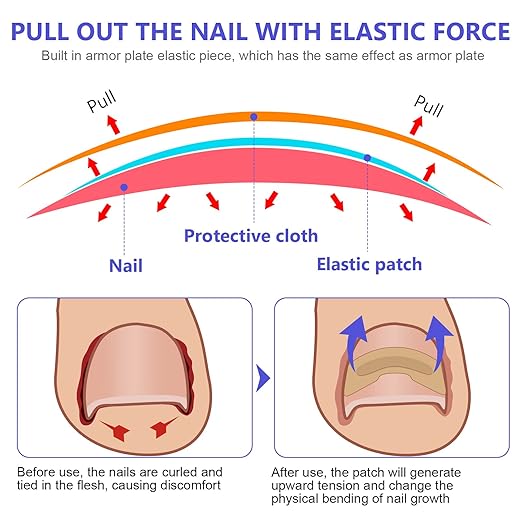 Fungus Nail Patches | Ingrown Nail Treatment-Nail Patches-Lightsnest