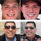 Removable Veneers | Clip On Teeth-Denture-Lightsnest