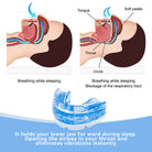 Snoring Mouthpiece | Stop Snoring Mouthpiece-Snoring Device-Lightsnest