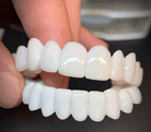 False Teeth | Teeth Coverings-Denture-Lightsnest